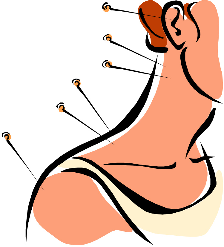 Acupuncture